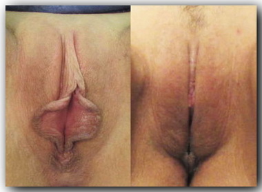 réduction des petites lèvres et du capuchon du clitoris 