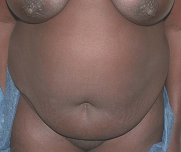 Déformations de l'abdome touchant la peau, la graisse et les muscles