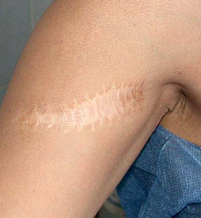 Cicatrice large sur le bras