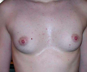 Hypotrophie mammaire chez une jeune fille d'1m 68