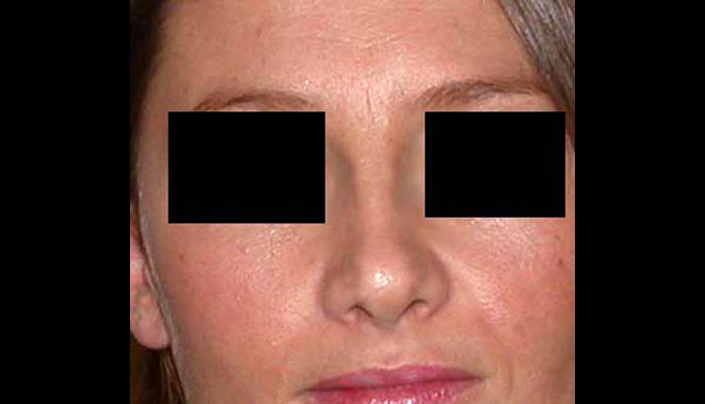 chirurgie-esthetique-interventions-nez-rhinoplasties