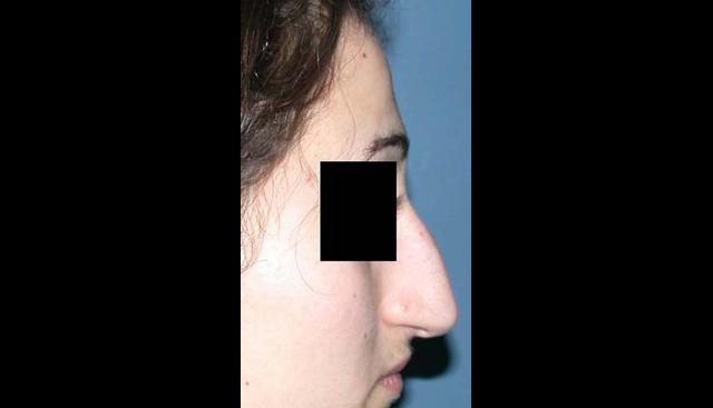 chirurgie-esthetique-interventions-nez-rhinoplasties