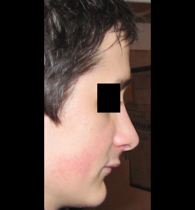 rhinoplastie esthétique