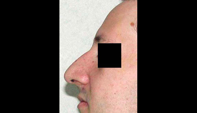 chirurgie-esthetique-interventions-nez-rhinoplasties