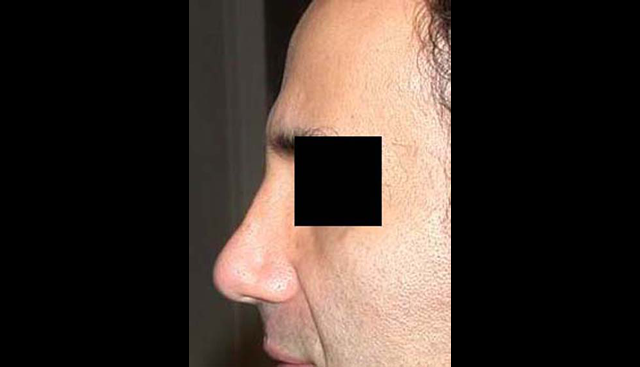 chirurgie-esthetique-interventions-nez-rhinoplasties