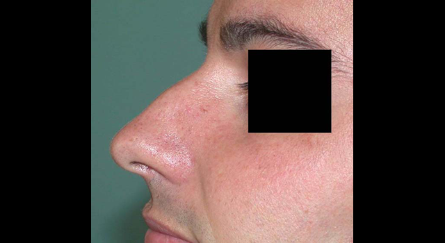 chirurgie-esthetique-interventions-nez-rhinoplasties