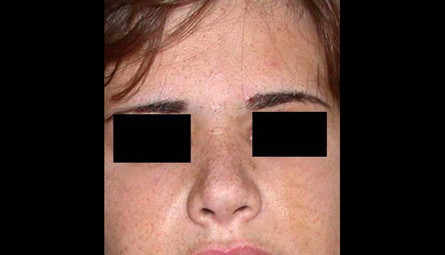 chirurgie-esthetique-interventions-nez-rhinoplasties