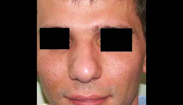 chirurgie-esthetique-interventions-nez-rhinoplasties