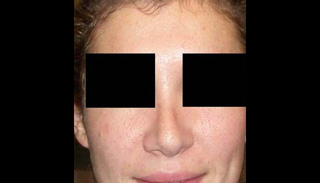 chirurgie-esthetique-interventions-nez-rhinoplasties