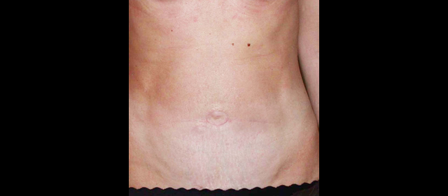 chirurgie-esthetique-interventions-abdomens-abdominoplasties