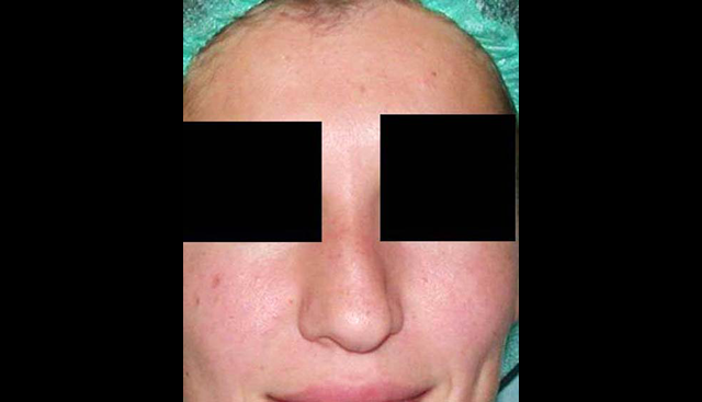 chirurgie-esthetique-interventions-nez-rhinoplasties