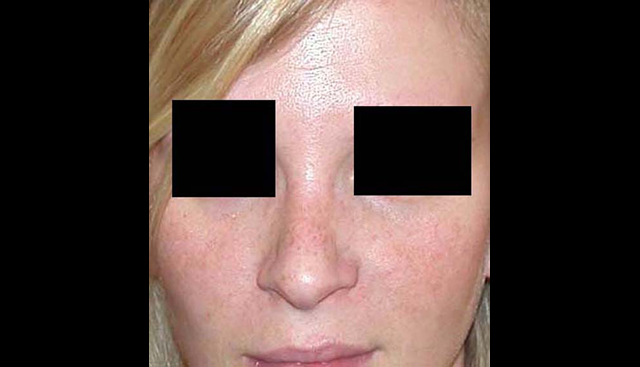 chirurgie-esthetique-interventions-nez-rhinoplasties