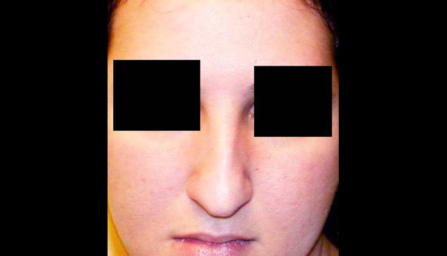 chirurgie-esthetique-interventions-nez-rhinoplasties