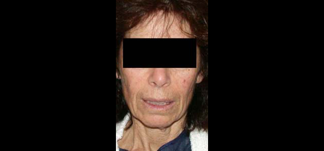 chirurgie-esthetique-interventions-visage-liftings