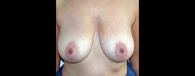 chirurgie-esthetique-interventions-seins-reductions-mammaires