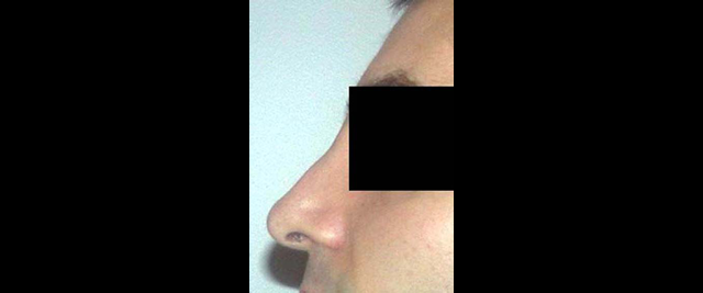 chirurgie-esthetique-chirurgie-secondaire-nez-rhinoplastie-secondaire
