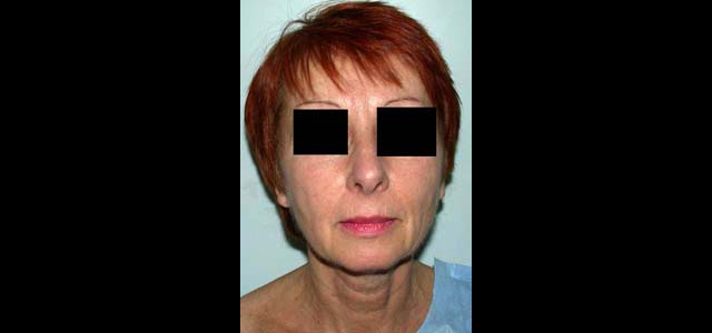 chirurgie-esthetique-interventions-visage-liftings