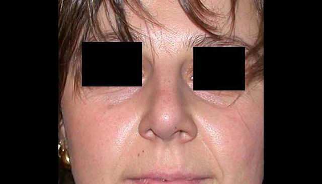 chirurgie-esthetique-interventions-nez-rhinoplasties