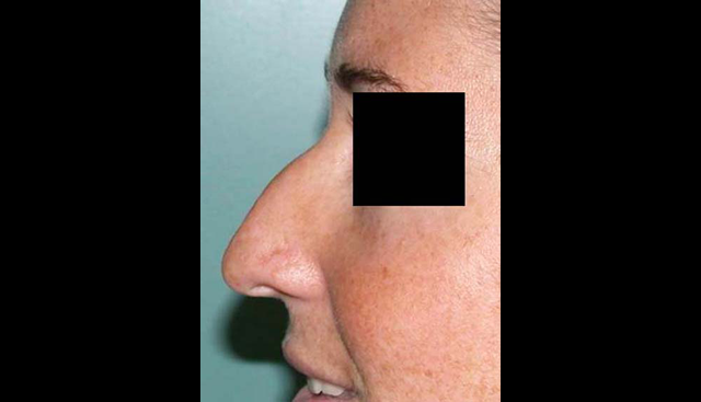 chirurgie-esthetique-interventions-nez-rhinoplasties