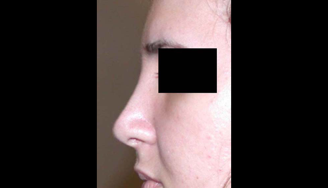 chirurgie-esthetique-interventions-nez-rhinoplasties