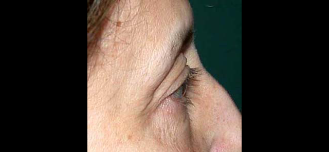 chirurgie-esthetique-interventions-paupieres-blépharoplasties
