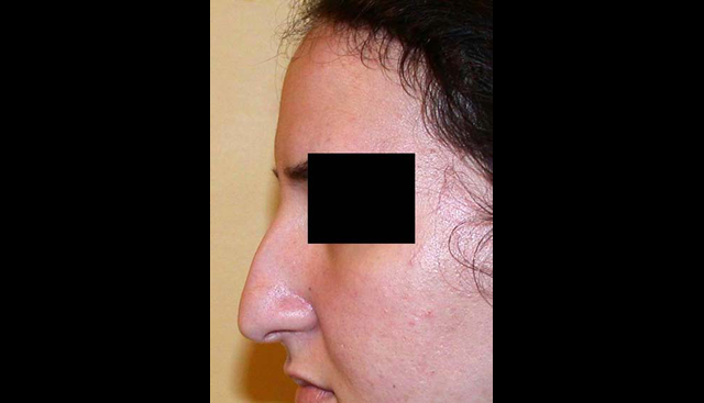 chirurgie-esthetique-interventions-nez-rhinoplasties