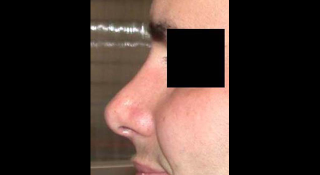 chirurgie-esthetique-interventions-nez-rhinoplasties