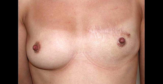 chirurgie-esthetique-interventions-chirurgie-secondaire-seins