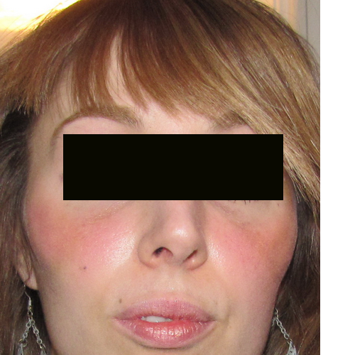 résultat post-opératoire au 7ème jour