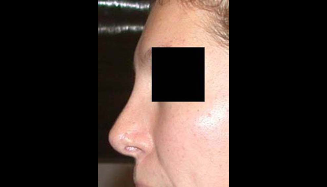 chirurgie-esthetique-interventions-nez-rhinoplasties