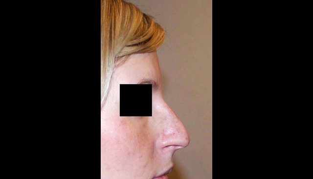 chirurgie-esthetique-interventions-nez-rhinoplasties