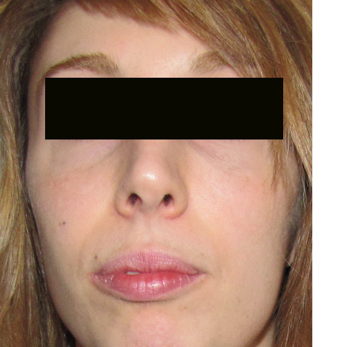 patiente demandeuse d'implants malaire ; Photo pré opératoire