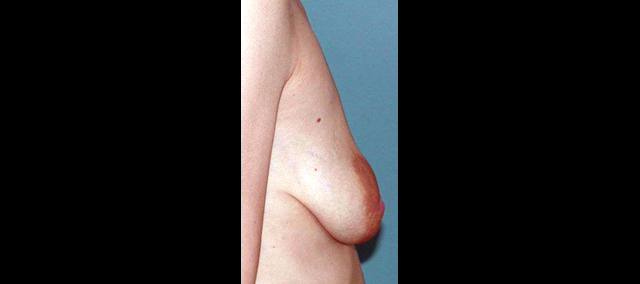 chirurgie-esthetique-interventions-seins-correction-ptose-avec-implants