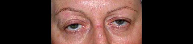 chirurgie-esthetique-interventions-paupieres-blépharoplasties
