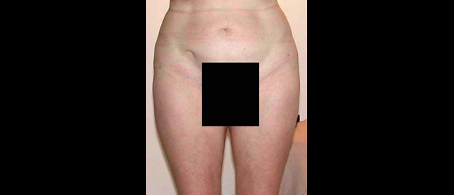 chirurgie-esthetique-interventions-lipoaspirations-liposuccions