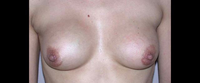 chirurgie-esthetique-interventions-chirurgie-secondaire-seins