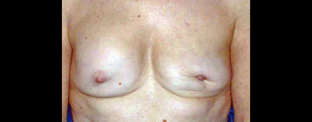 chirurgie-esthetique-interventions-chirurgie-secondaire-seins
