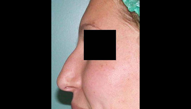 chirurgie-esthetique-interventions-nez-rhinoplasties