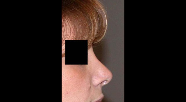 chirurgie-esthetique-interventions-nez-rhinoplasties