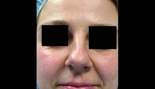 chirurgie-esthetique-interventions-nez-rhinoplasties