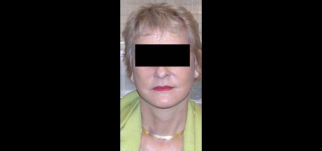 chirurgie-esthetique-interventions-visage-liftings