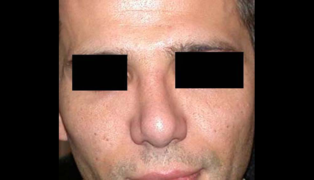 chirurgie-esthetique-interventions-nez-rhinoplasties