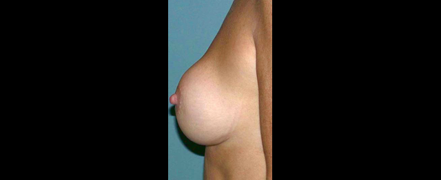 chirurgie-esthetique-interventions-chirurgie-secondaire-seins