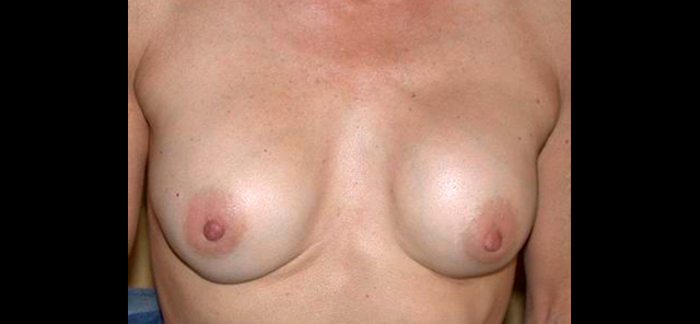 chirurgie-esthetique-interventions-chirurgie-secondaire-seins