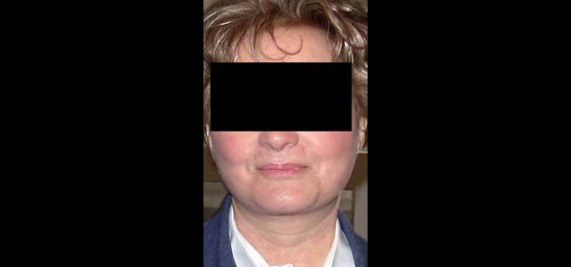 chirurgie-esthetique-interventions-visage-liftings