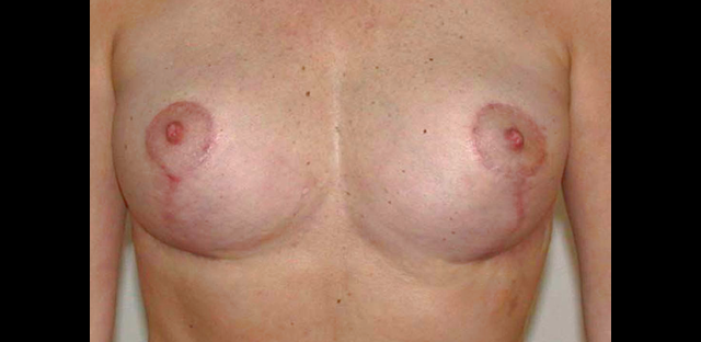 chirurgie-esthetique-interventions-seins-ptoses-mammaires-sans-implant