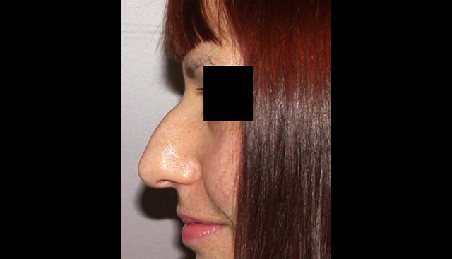 chirurgie-esthetique-interventions-nez-rhinoplasties