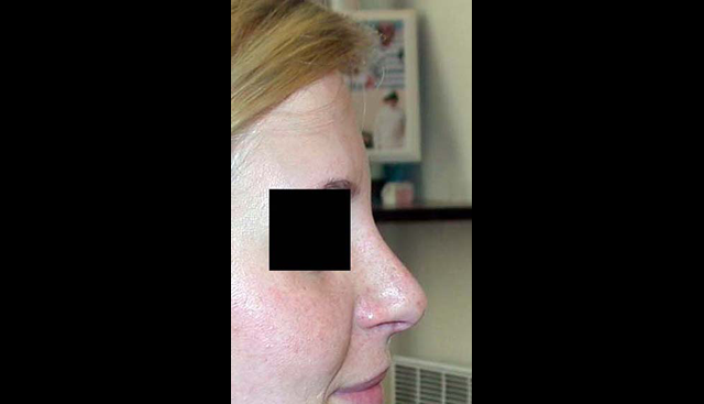 chirurgie-esthetique-interventions-nez-rhinoplasties
