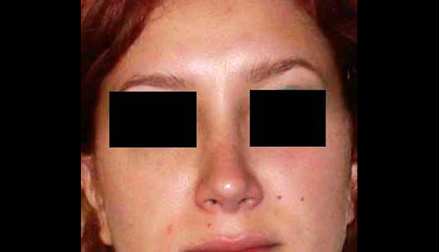 chirurgie-esthetique-interventions-nez-rhinoplasties