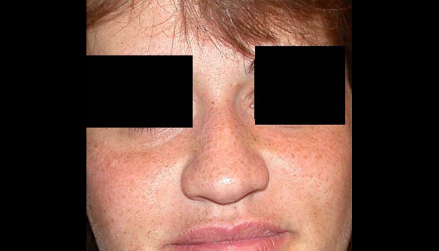 chirurgie-esthetique-interventions-nez-rhinoplasties
